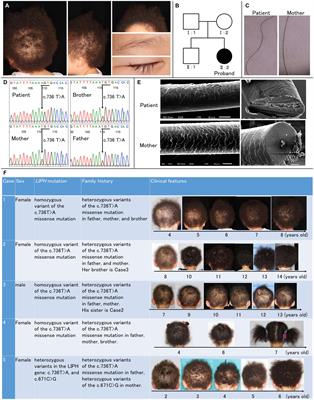 Case report: Exploring autosomal recessive woolly hair: genetic and scanning electron microscopic perspectives on a Japanese patient